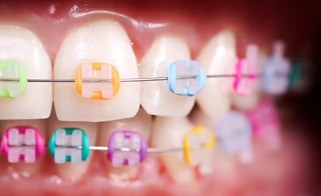 Close-up of colorful braces