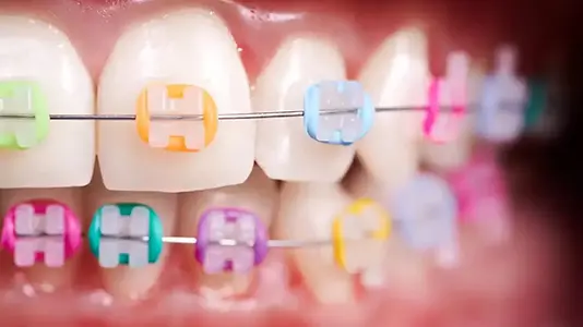 Close-up of colorful braces
