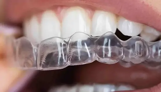 Clear aligner on teeth