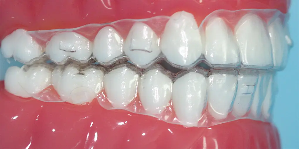 Dental display model showing clear aligners