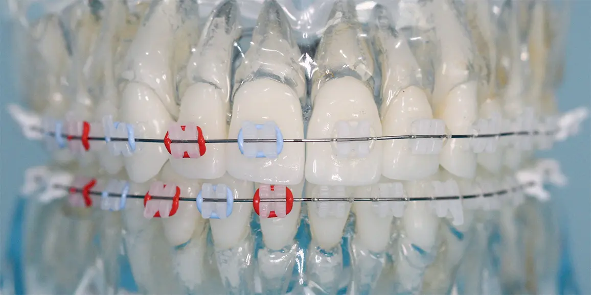 Dental display model showing clear ceramic braces