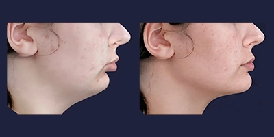 Facial profile simulation showing an example of projected orthodontic treatment changes