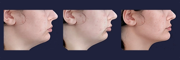 Dentofacial simulation