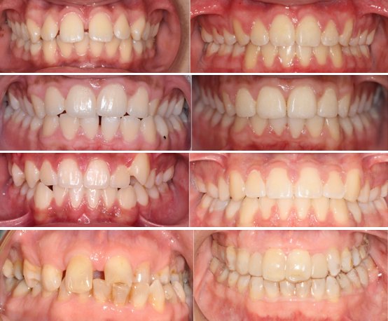 Orthodontic treatment space