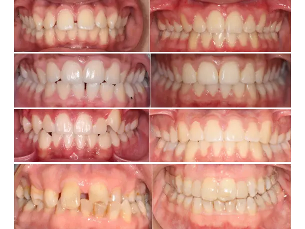 Orthodontic treatment space