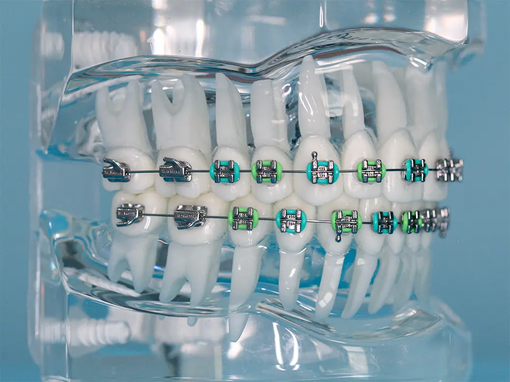 Dental display model showing metal braces