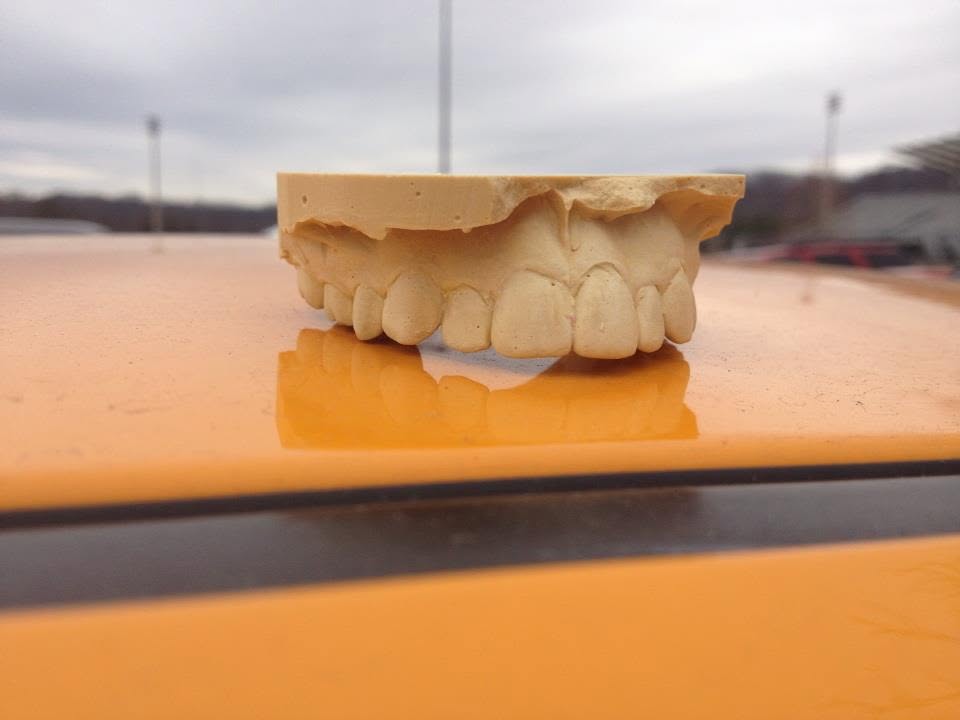 Dental impression from Zack's early orthodontic experience